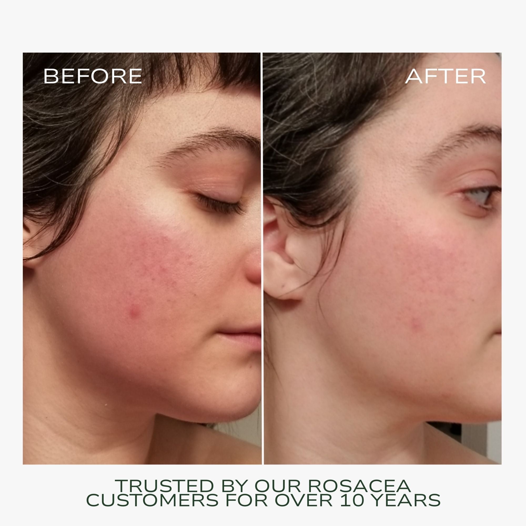 Redness Rescue Cream (RRC)